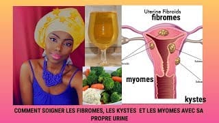 COMMENT SOIGNER LES FIBROMES , KYSTES , MYOMES AVEC SA PROPRE URINE 1 WEMW3l