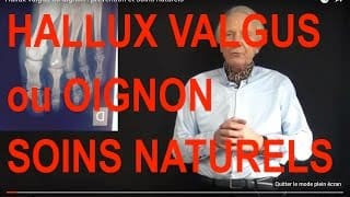 Vidéo Comment soigner le hallux valgus ou oignon ? Soins naturels par Guy Roulier 1 iRdWgw