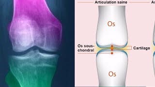 Comment soigner et régénérer le cartilage du genou naturellement 1
